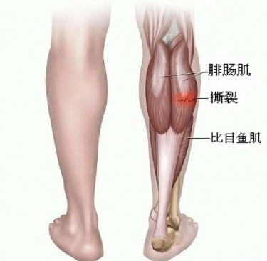 认识肌肉拉伤!